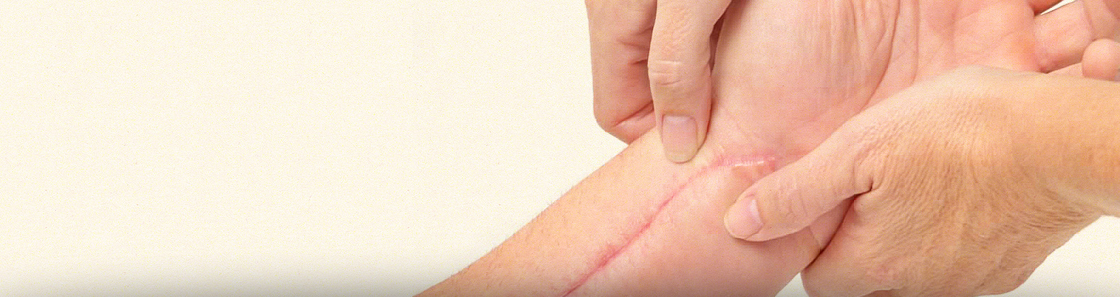 Cicatrizes e Quelóides | Dr. Rodrigo Pimenta